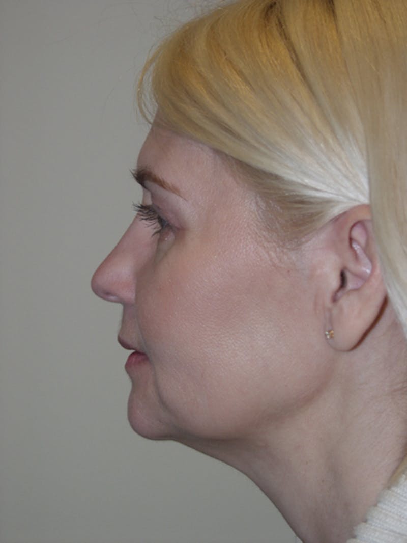 Rhinoplasty Before & After Gallery - Patient 52668586 - Image 1