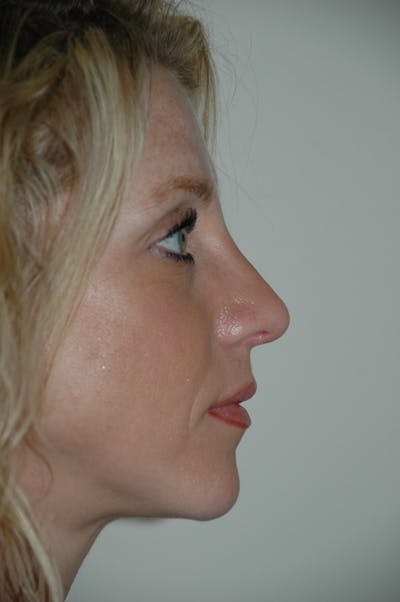 Rhinoplasty Before & After Gallery - Patient 52507131 - Image 2