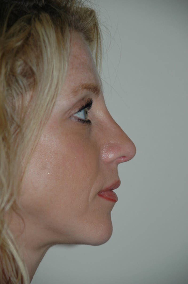 Rhinoplasty Before & After Gallery - Patient 52507131 - Image 2