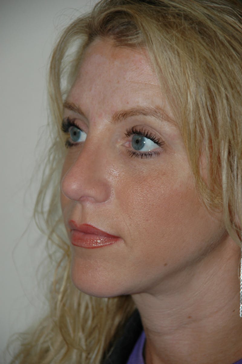 Rhinoplasty Before & After Gallery - Patient 52507131 - Image 6