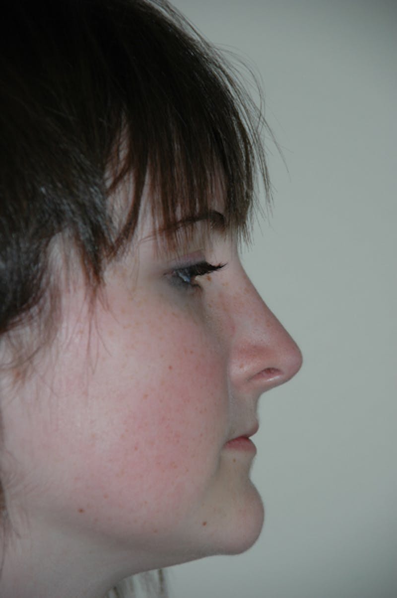 Rhinoplasty Before & After Gallery - Patient 52507133 - Image 2