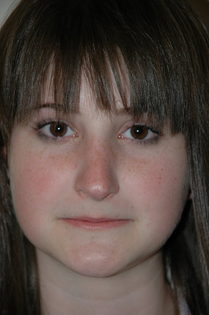 Rhinoplasty Before & After Gallery - Patient 52507133 - Image 4