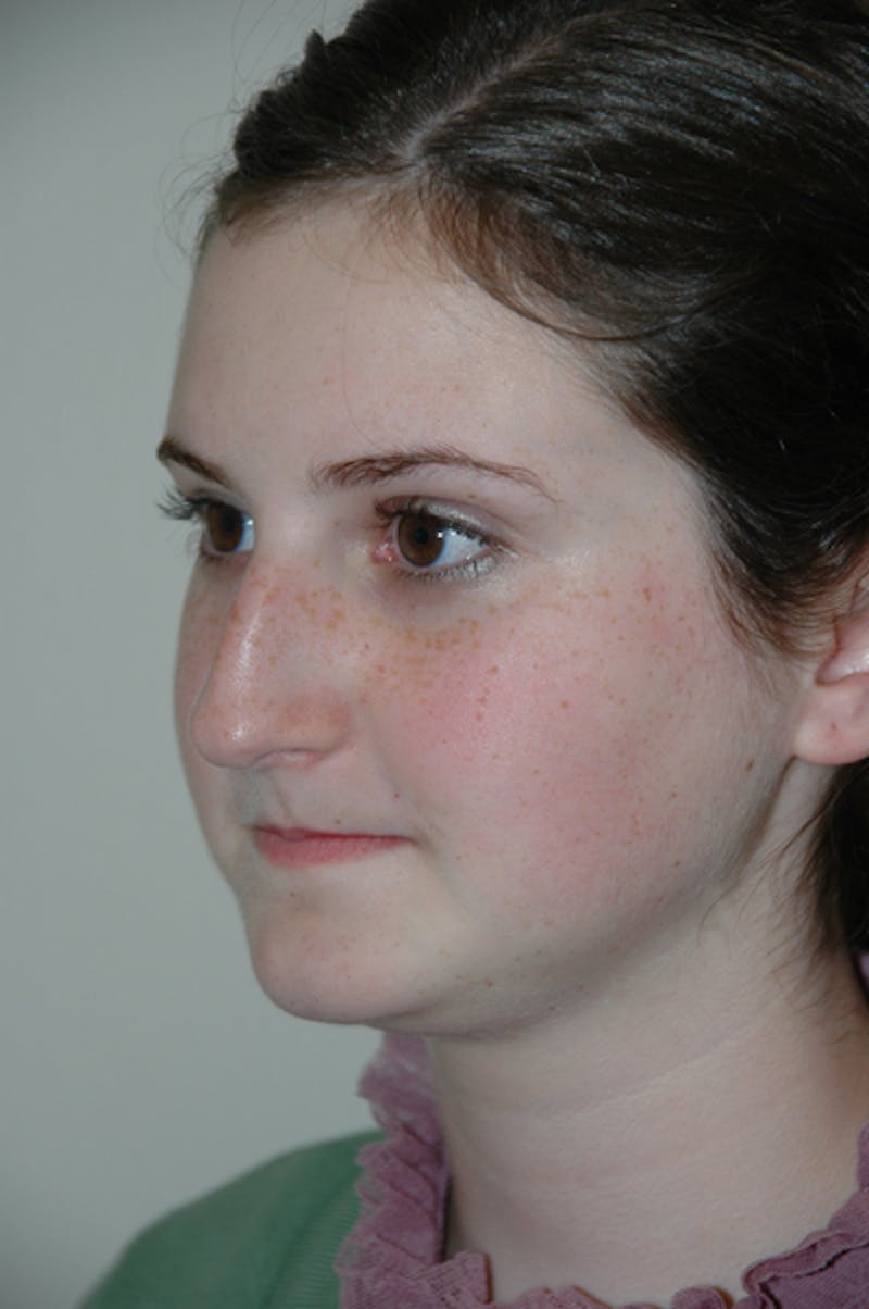 Rhinoplasty Before & After Gallery - Patient 52507133 - Image 5