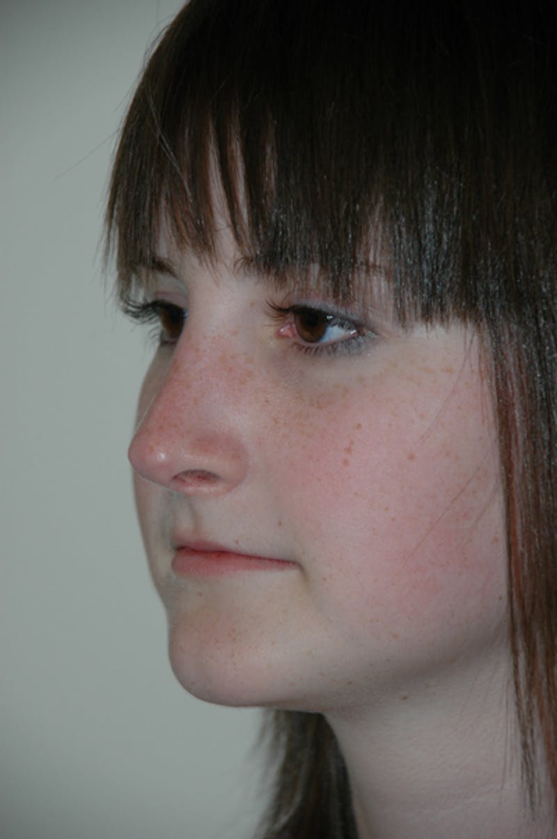 Rhinoplasty Before & After Gallery - Patient 52507133 - Image 6