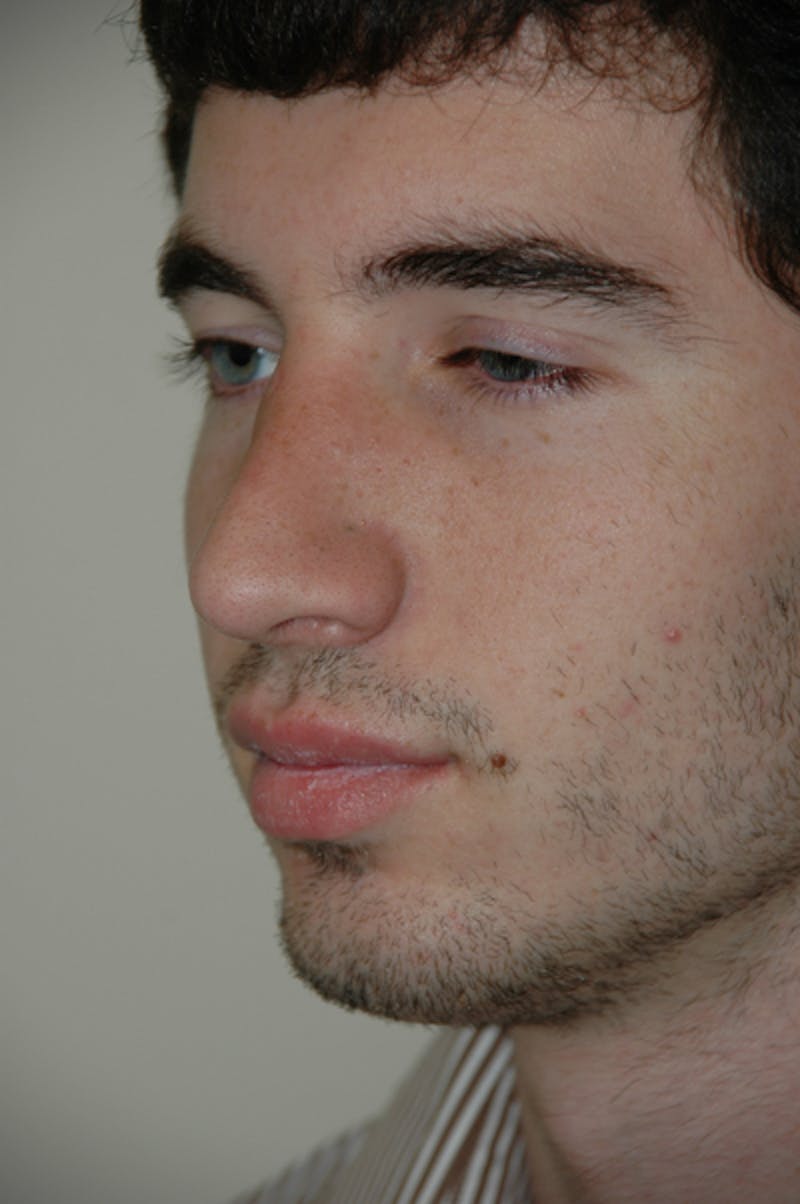 Rhinoplasty Before & After Gallery - Patient 52507134 - Image 4