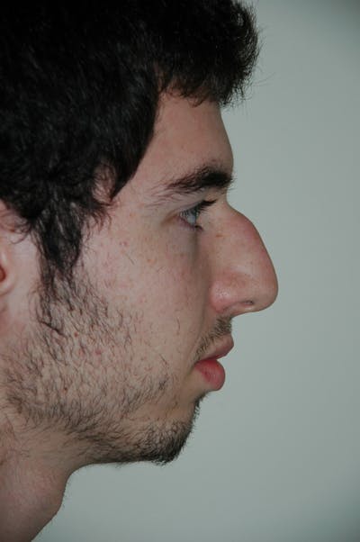 Rhinoplasty Before & After Gallery - Patient 52507134 - Image 1