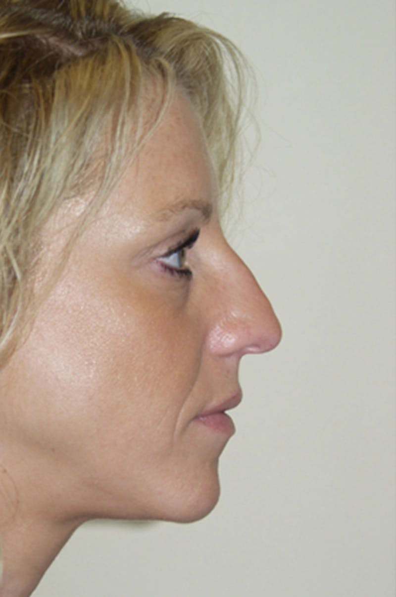Rhinoplasty Before & After Gallery - Patient 52507131 - Image 1