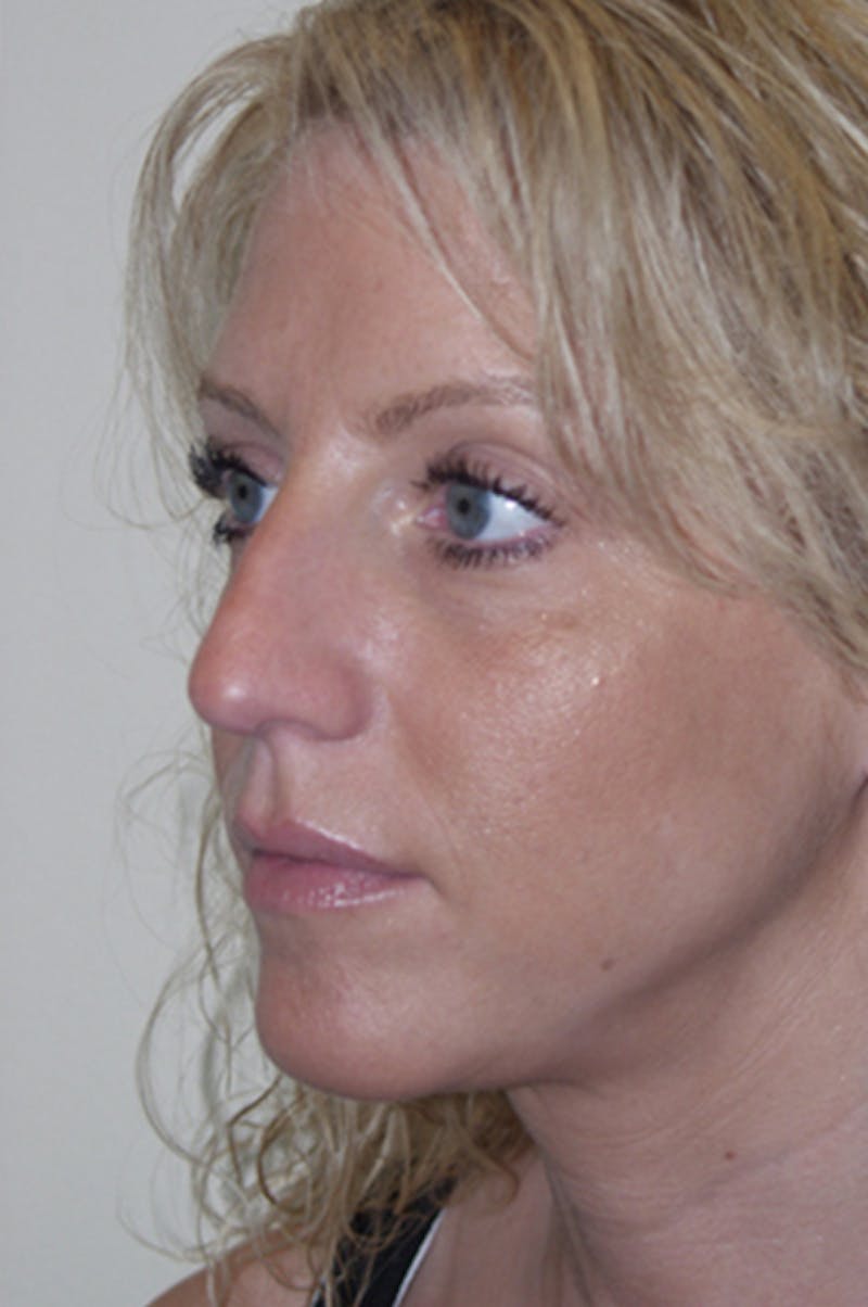 Rhinoplasty Before & After Gallery - Patient 52507131 - Image 5