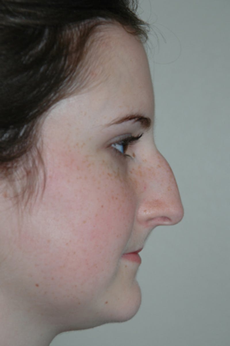 Rhinoplasty Before & After Gallery - Patient 52507133 - Image 1