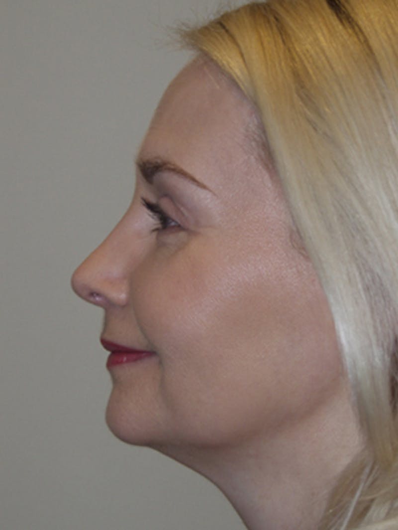 Mid-face lift Before & After Gallery - Patient 52668572 - Image 4