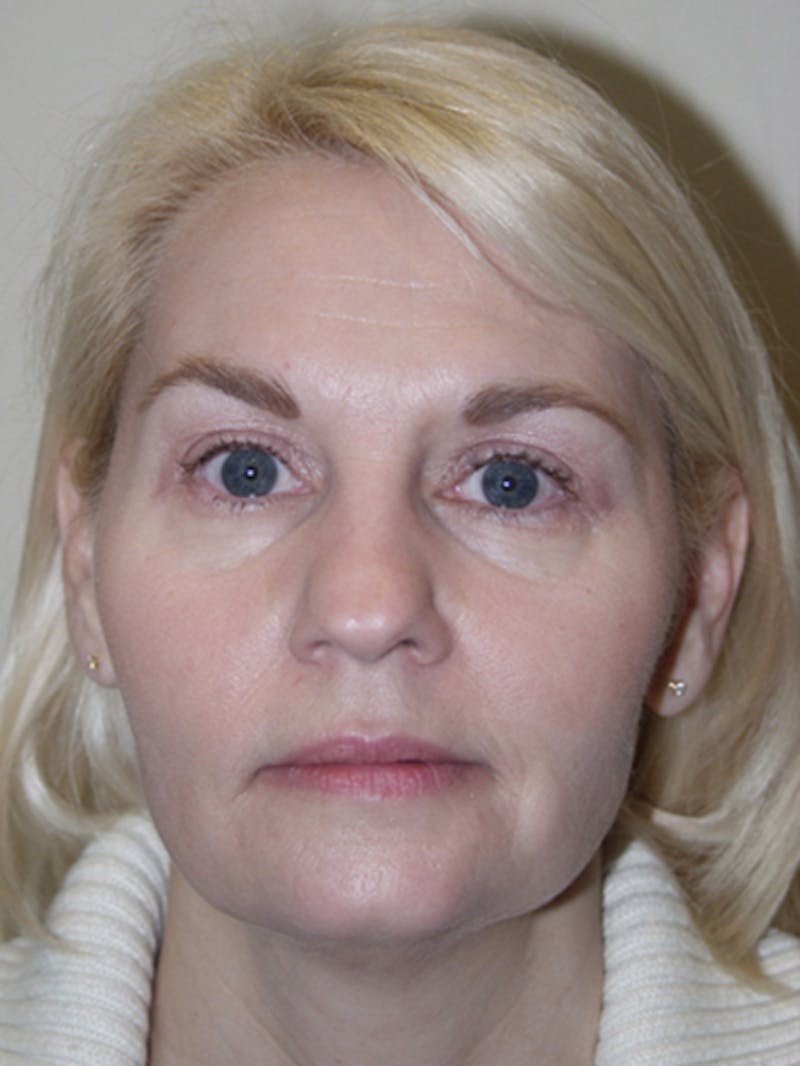 Mid-face lift Before & After Gallery - Patient 52668572 - Image 1