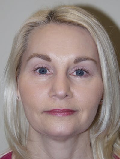 Facelift Before & After Gallery - Patient 53599888 - Image 2