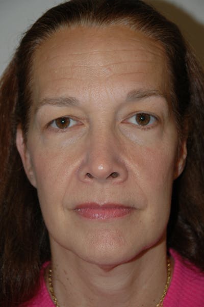 Brow/Forehead Before & After Gallery - Patient 973608 - Image 1