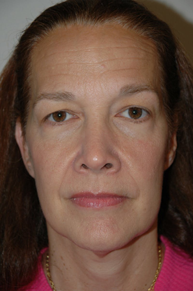 Mid-face lift Before & After Gallery - Patient 52668573 - Image 1