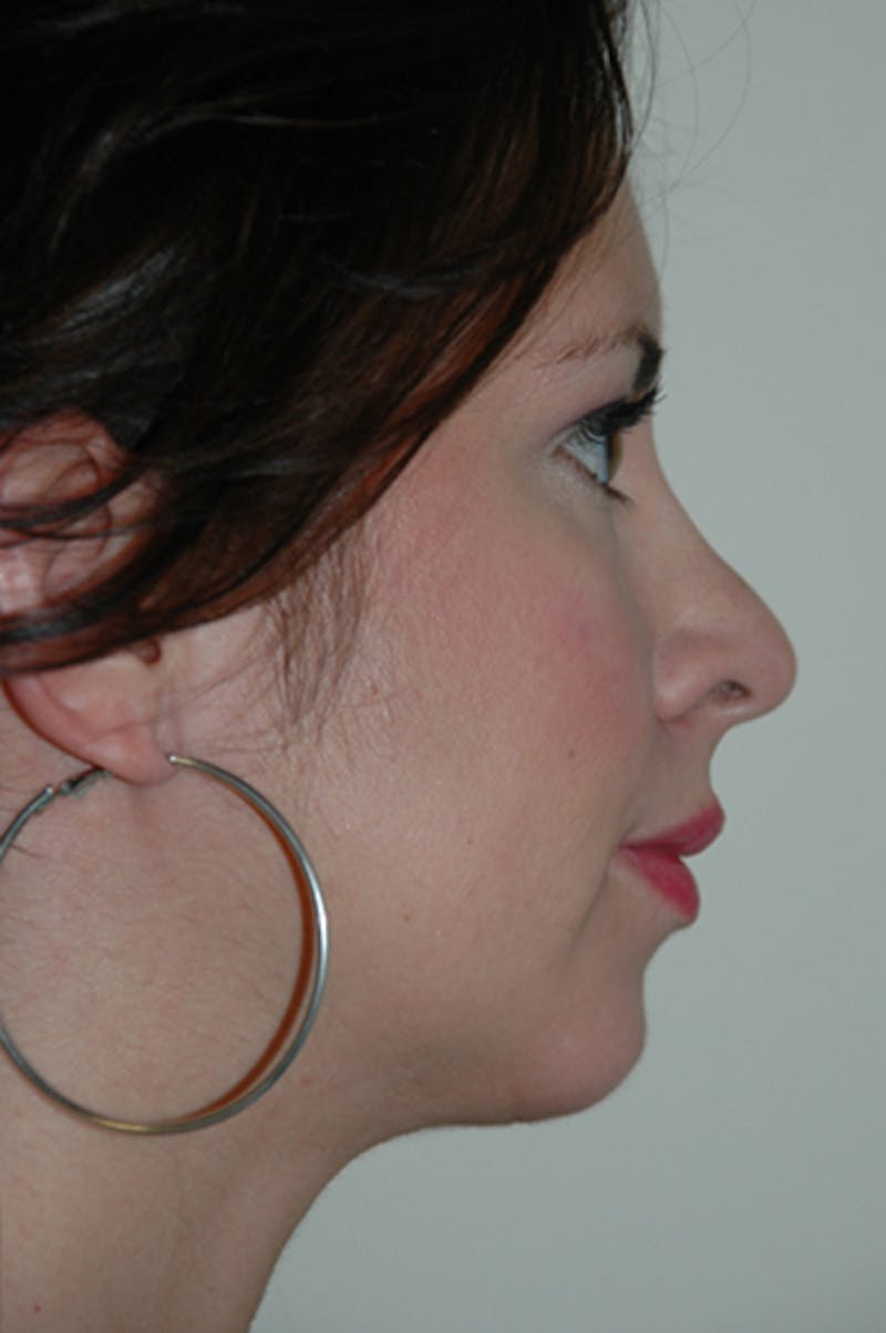 Chin Implant Before & After Gallery - Patient 50814954 - Image 2