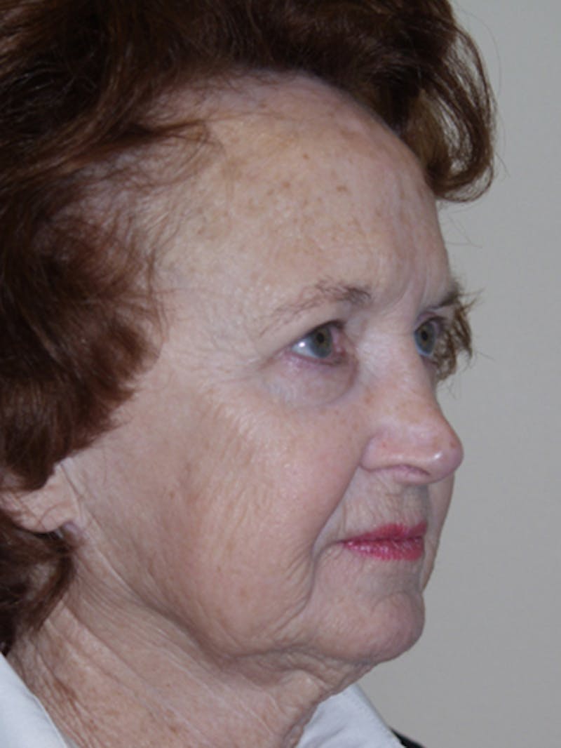 Full Face Laser Gallery - Patient 52506958 - Image 3