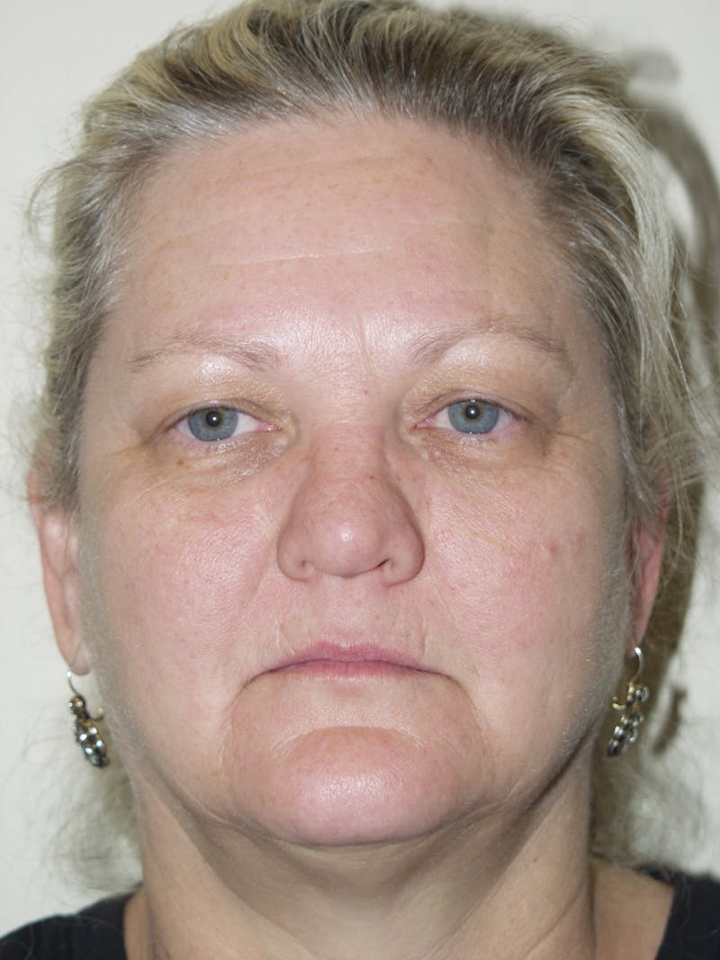Eyelid surgery Before & After Gallery - Patient 53599591 - Image 1