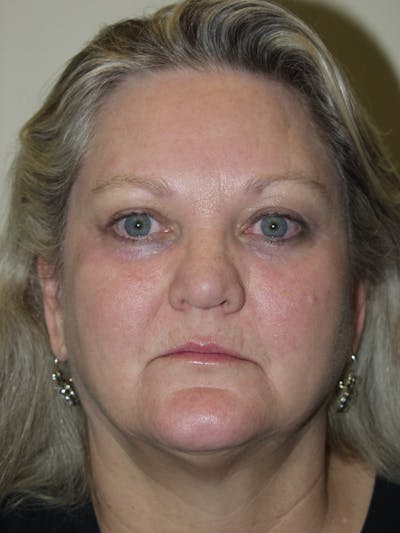 Eyelid surgery Before & After Gallery - Patient 53599591 - Image 2