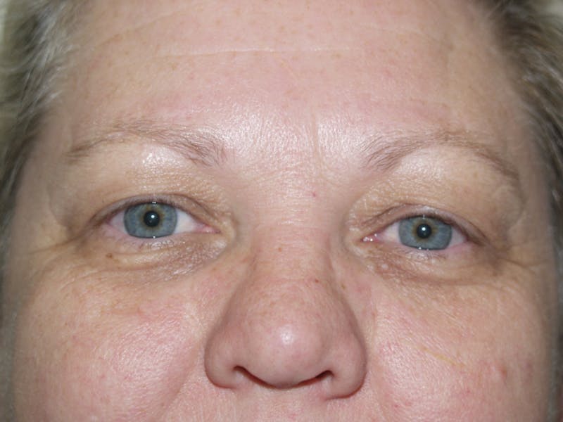 Eyelid surgery Before & After Gallery - Patient 53599591 - Image 3