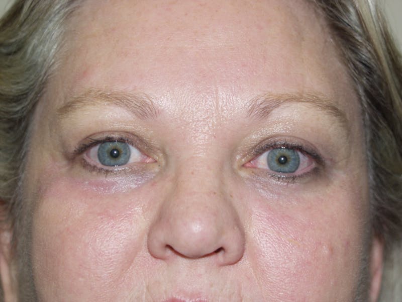 Eyelid surgery Before & After Gallery - Patient 53599591 - Image 4