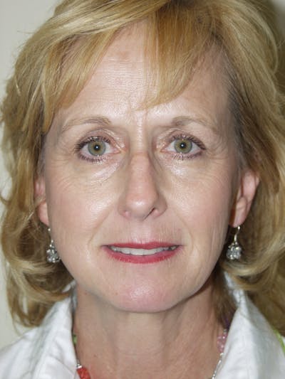 Eyelid surgery Before & After Gallery - Patient 53599595 - Image 1