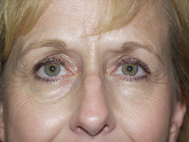 Eyelid surgery Before & After Gallery - Patient 53599595 - Image 3