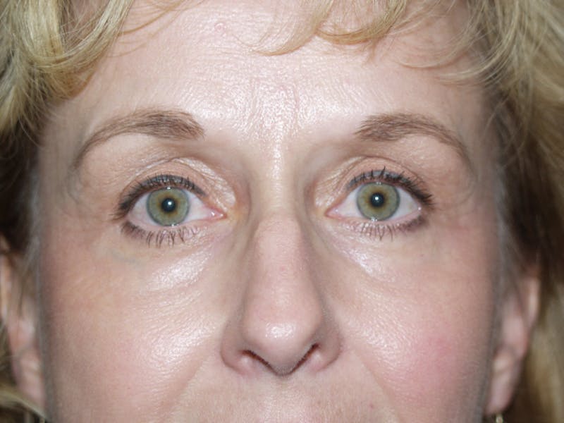 Eyelid surgery Before & After Gallery - Patient 53599595 - Image 4