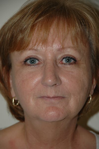 Eyelid surgery Before & After Gallery - Patient 53599596 - Image 2
