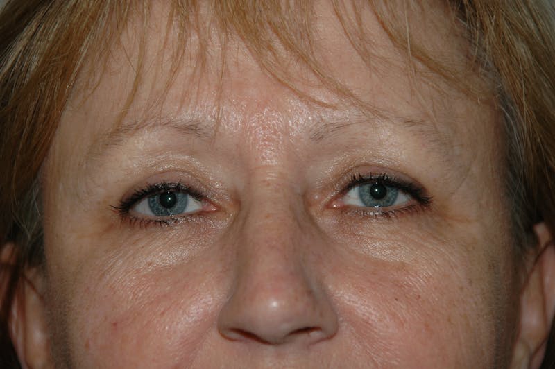 Eyelid surgery Gallery - Patient 53599596 - Image 3