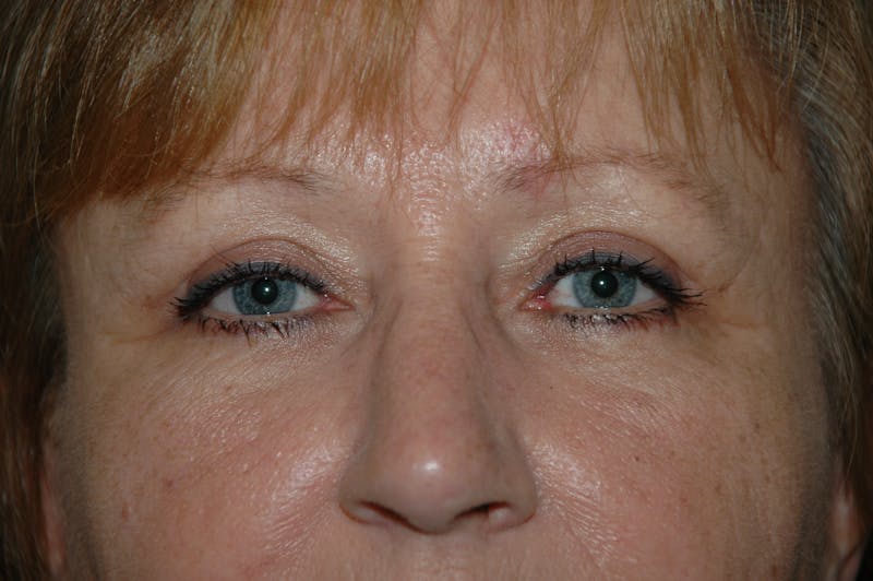 Eyelid surgery Gallery - Patient 53599596 - Image 4