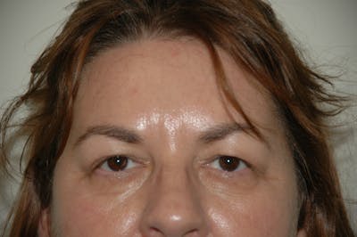 Eyelid surgery Before & After Gallery - Patient 53599611 - Image 1