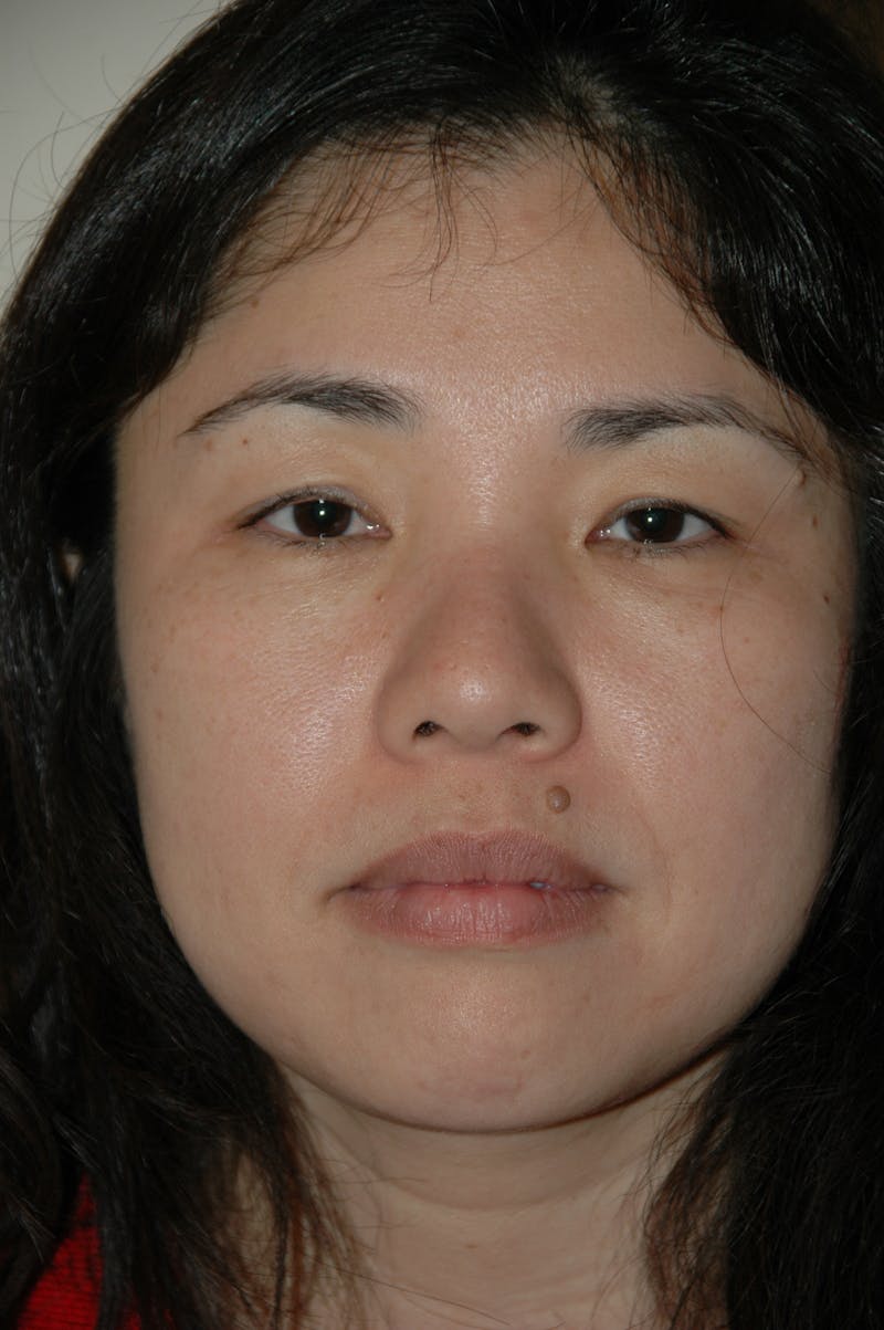 Eyelid surgery Before & After Gallery - Patient 53599628 - Image 1