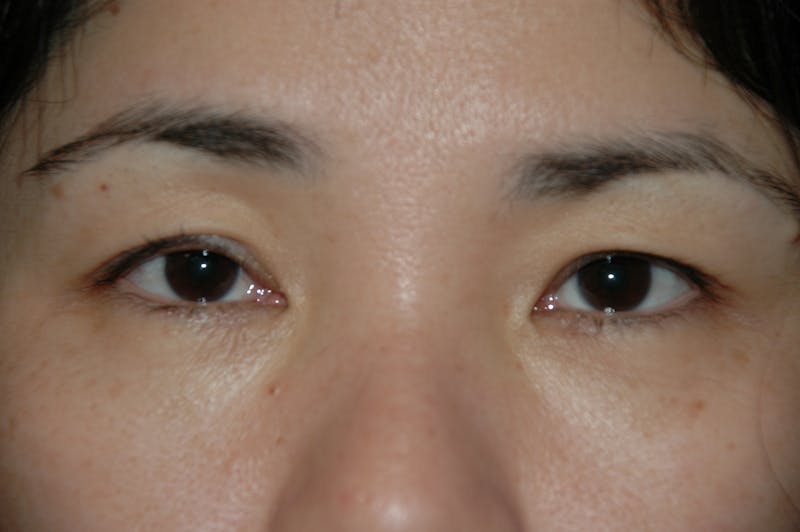 Eyelid surgery Before & After Gallery - Patient 53599628 - Image 3