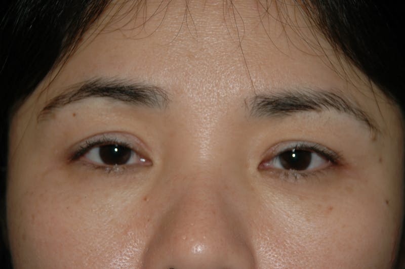 Eyelid surgery Before & After Gallery - Patient 53599628 - Image 4