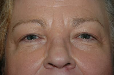 Eyelid surgery Before & After Gallery - Patient 53599679 - Image 1
