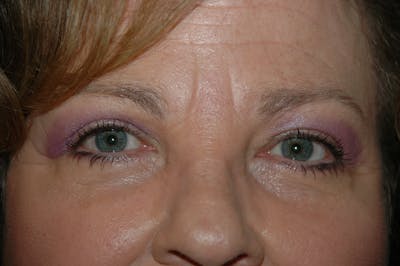 Eyelid surgery Gallery - Patient 53599679 - Image 2
