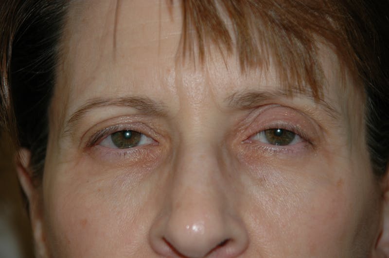 Eyelid surgery Before & After Gallery - Patient 53599680 - Image 1
