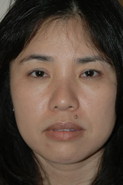 Eyelid surgery Before & After Gallery - Patient 53599628 - Image 2