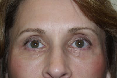 Eyelid surgery Before & After Gallery - Patient 53599680 - Image 2