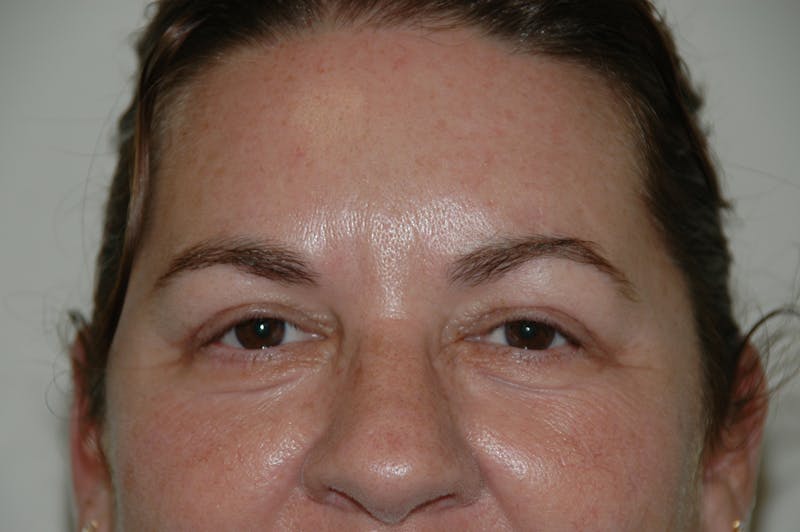 Eyelid surgery Before & After Gallery - Patient 53599611 - Image 2