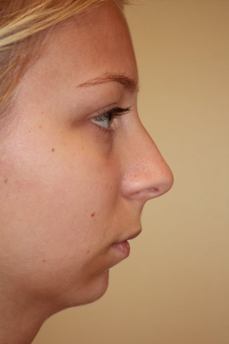 Chin Implant Before & After Gallery - Patient 53599803 - Image 1