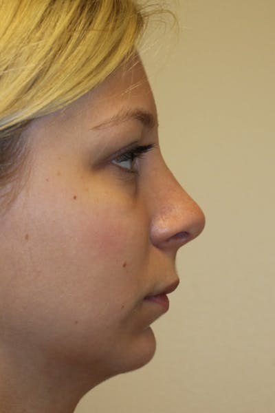 Chin Implant Before & After Gallery - Patient 53599803 - Image 2