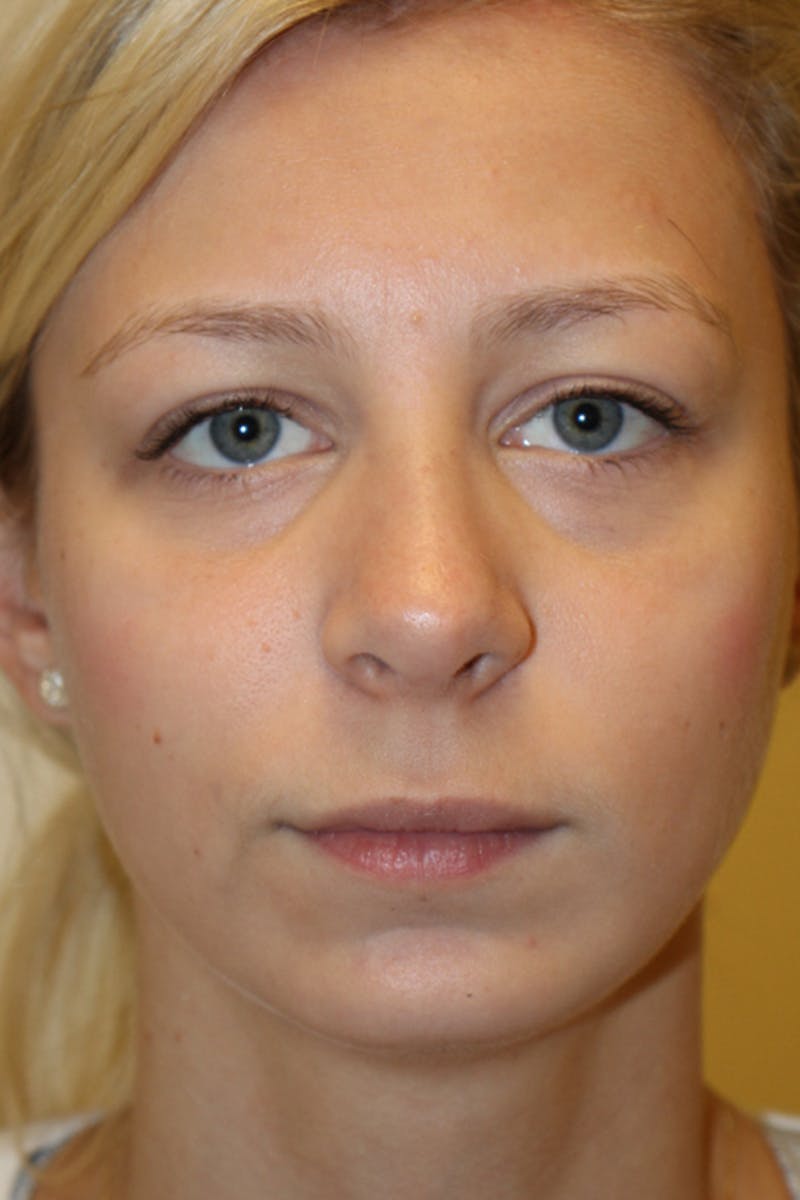 Chin Implant Before & After Gallery - Patient 53599803 - Image 4