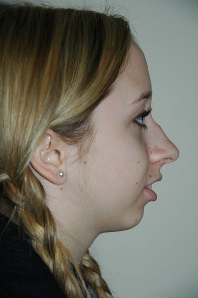 Chin Implant Before & After Gallery - Patient 53599838 - Image 1