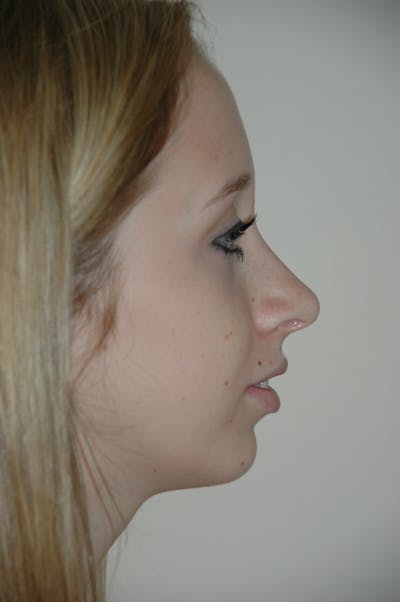 Chin Implant Before & After Gallery - Patient 53599838 - Image 2