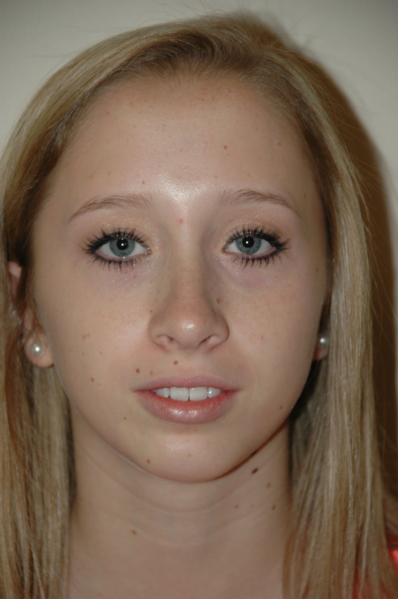 Chin Implant Before & After Gallery - Patient 53599838 - Image 4