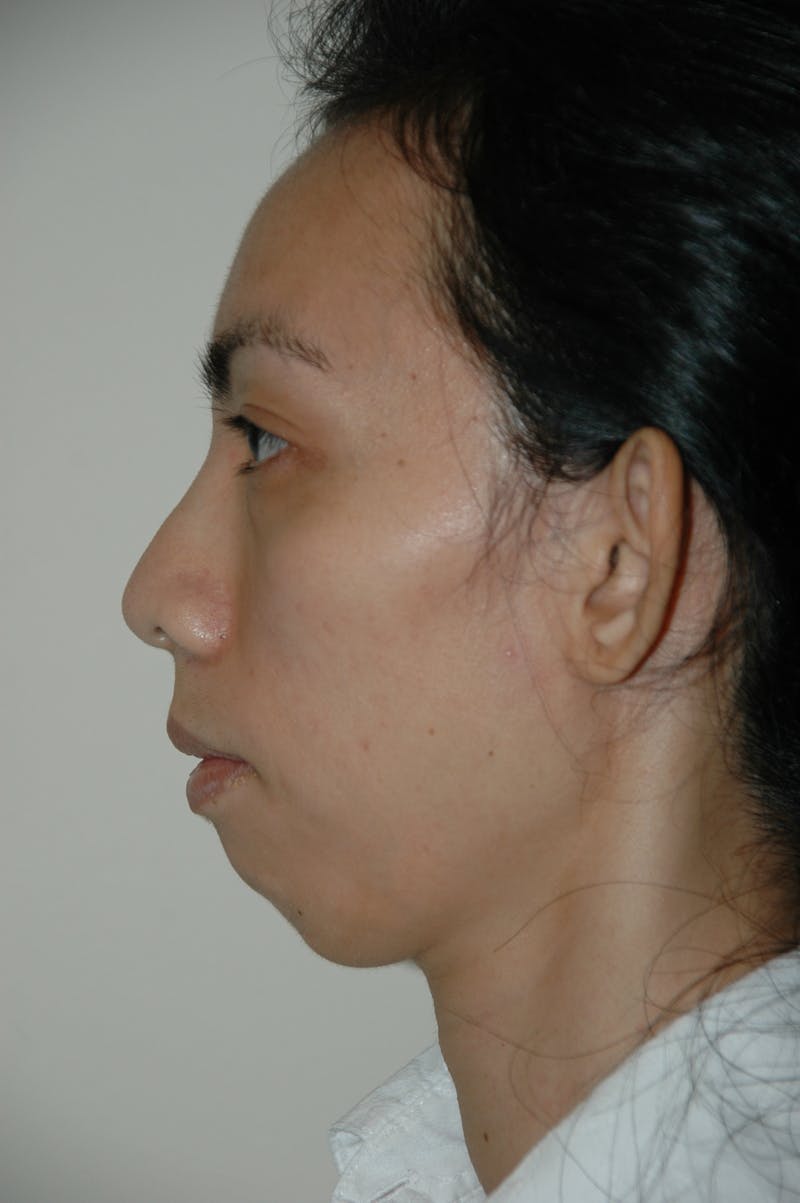 Chin Implant Before & After Gallery - Patient 53599848 - Image 1