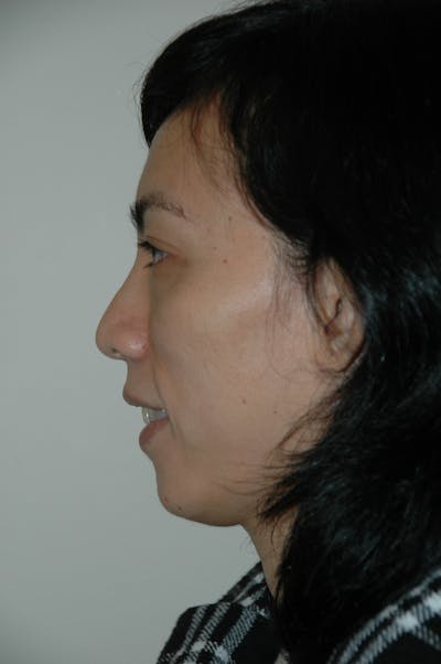 Chin Implant Before & After Gallery - Patient 53599848 - Image 2