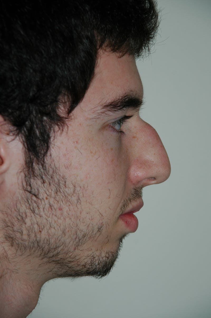 Chin Implant Before & After Gallery - Patient 53599849 - Image 1