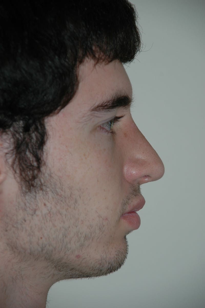 Chin Implant Before & After Gallery - Patient 53599849 - Image 2